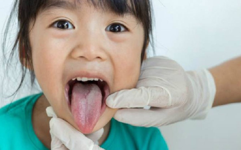 Nấm lưỡi ở trẻ 2 tuổi khiến nhiều cha mẹ lo lắng