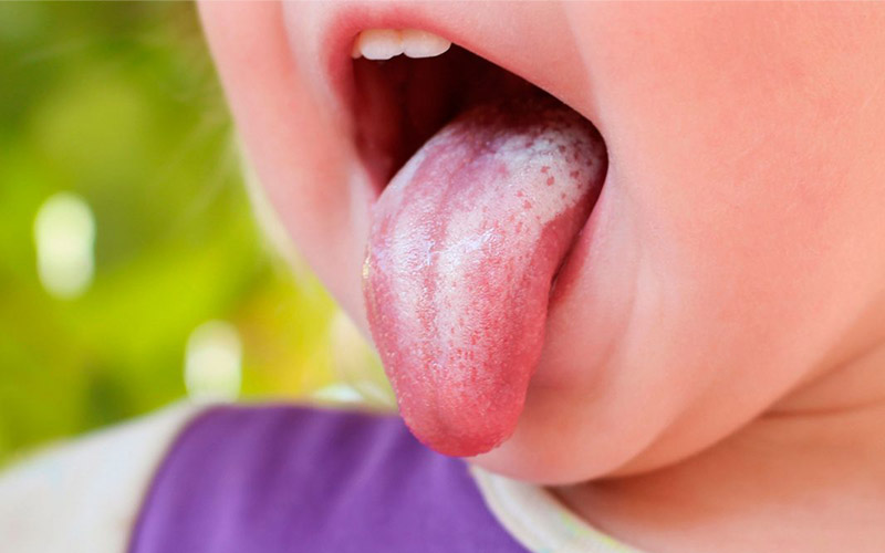 Nguyên nhân dẫn đến nấm lưỡi ở trẻ 3 tuổi