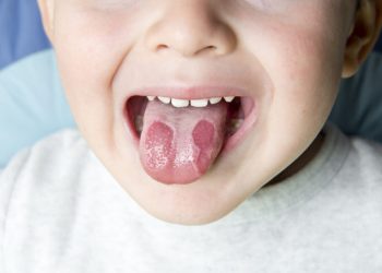 Nấm Lưỡi Ở Trẻ 3 Tuổi: Nhận Biết Triệu Chứng Và Cách Chữa