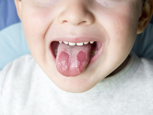 Nấm Lưỡi Ở Trẻ 3 Tuổi: Nhận Biết Triệu Chứng Và Cách Chữa