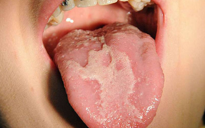 Nấm lưỡi ở trẻ em gây ra cảm giác khó chịu, đau rát