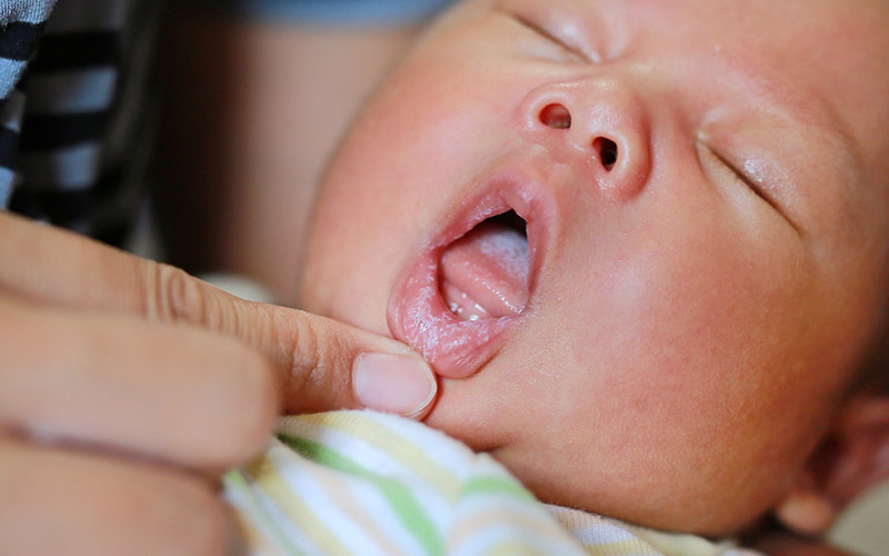 Các chấm trắng ở lưỡi là dấu hiệu giúp nhận biết trẻ sơ sinh bị nấm lưỡi