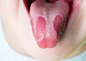 Nấm Lưỡi Ở Trẻ Em: Dấu Hiệu Nhận Biết Và Cách Điều Trị