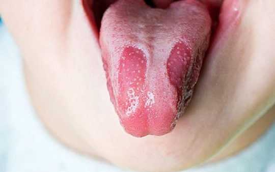 Nấm Lưỡi Ở Trẻ Em: Dấu Hiệu Nhận Biết Và Cách Điều Trị