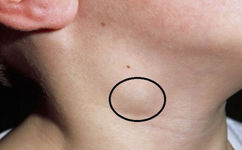 Hạch thường xuất hiện ở vùng da dưới cổ, cằm và má