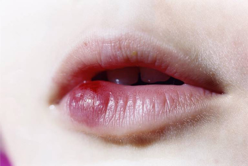 Nhiệt miệng sưng môi do các vết nhiệt lan rộng và viêm nhiễm nghiêm trọng