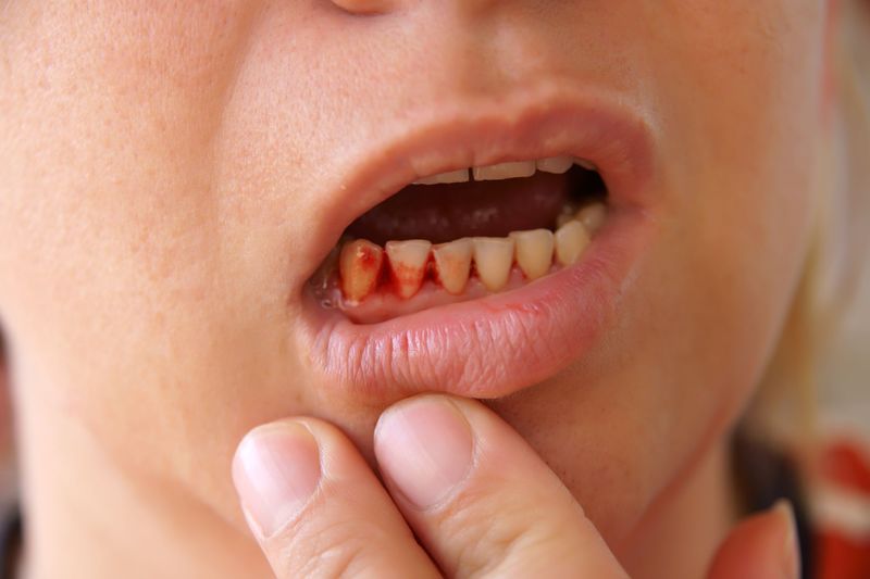 Sốt xuất huyết bị chảy máu chân răng là dấu hiệu cho thấy bệnh đang chuyển sang giai đoạn nghiêm trọng