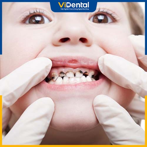 Sâu răng là một trong những nguyên nhân chính gây viêm tủy răng