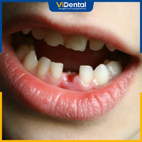 Việc mất răng quá sớm sẽ ảnh hưởng đến việc thay răng vĩnh viễn