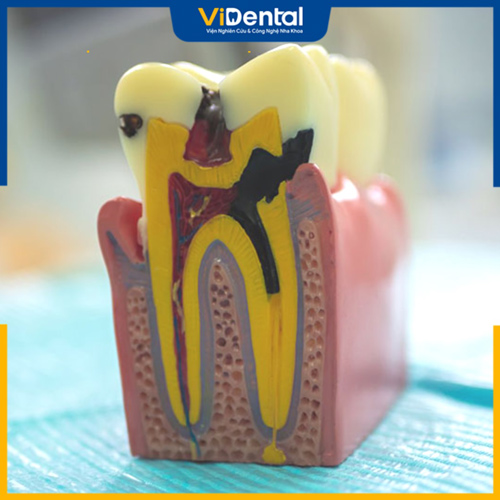 Viêm tủy răng có hồi phục là giai đoạn đầu của viêm nhiễm tủy răng