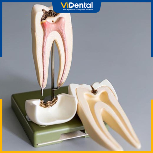 Có nhiều nguyên nhân gây nên tình trạng viêm tủy răng
