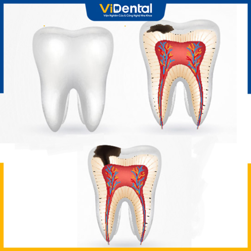 Viêm tủy răng có phục hồi có thể diễn tiến nặng gây biến chứng