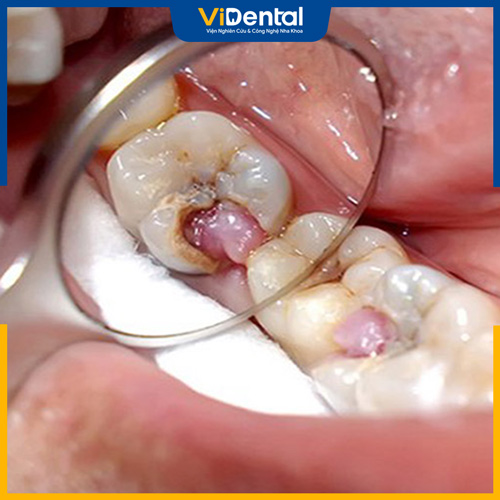 Viêm tủy răng nếu không chữa kịp thời có thể gây ra nhiều bệnh lý nguy hiểm