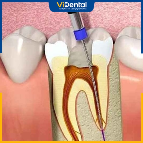 Khám, điều trị viêm tủy răng bằng nha khoa hiện đại đạt hiệu quả cao