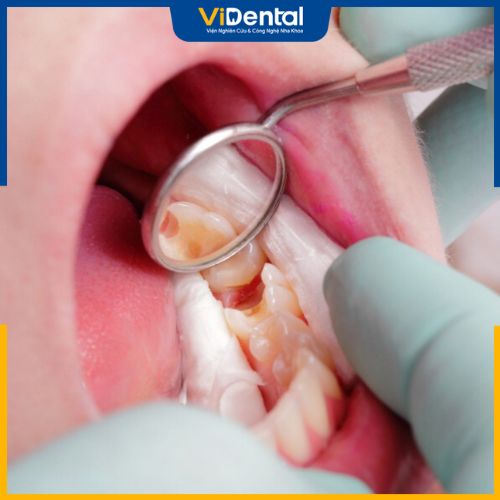 Viêm tủy răng có mủ xảy ra khi tình trạng viêm tủy răng chuyển biến nặng