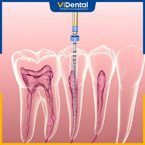 Viêm tủy răng là phản ứng bảo vệ của tủy răng với các tác nhân gây bệnh ở nhiều dạng tổn thương khác nhau.