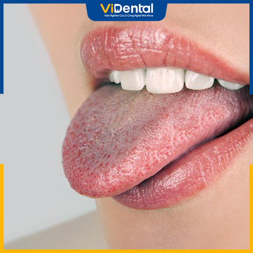 Nấm lưỡi là hiện tượng thường gặp ở cả trẻ em và người lớn
