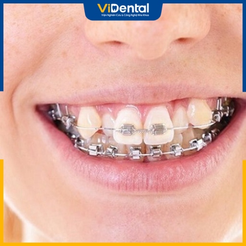 Niềng răng là phương pháp khắc phục hiệu quả tình trạng sai khớp cắn nghiêm trọng