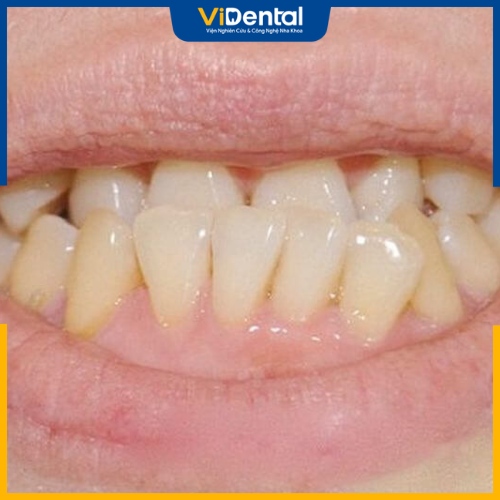 Răng mọc lệch lạc gây mất thẩm mỹ và ảnh hưởng đến sức khỏe