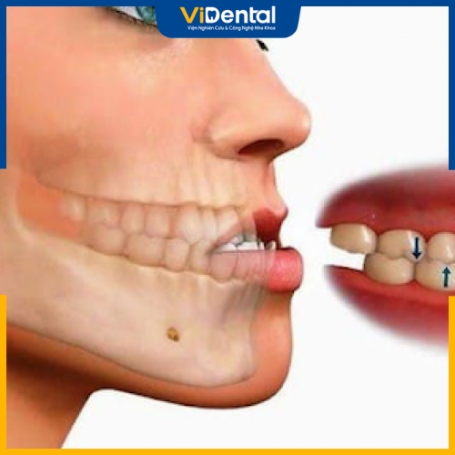 Mất răng là nguyên nhân hàng đầu gây nên tình trạng móm