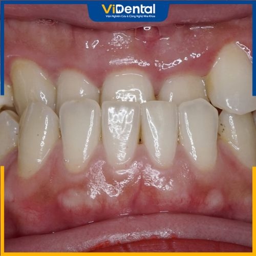Răng móm là tình trạng sai lệch khớp cắn gây mất tương quan hai hàm