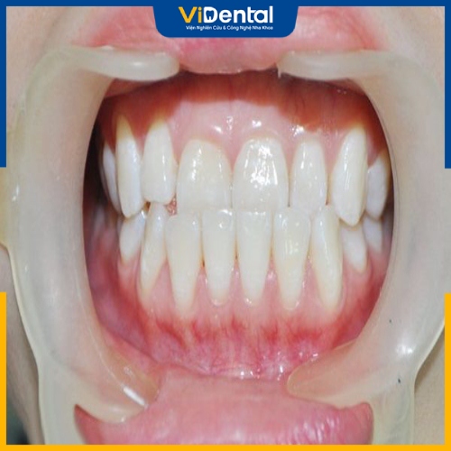 Răng móm có thể xuất phát từ di truyền, bẩm sinh