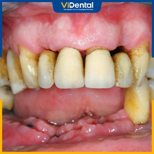 Chân răng viêm nhiễm gây ra nhiều biến chứng nguy hiểm